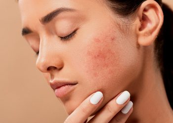 5 bước skincare trị mụn ẩn hiệu quả nhất: giúp da sạch mụn, tự tin chinh phục crush