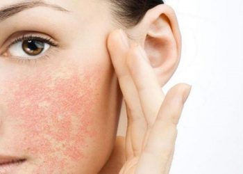 Cách chăm sóc cho da nhạy cảm dễ nổi mụn một cách an toàn, tránh kích ứng