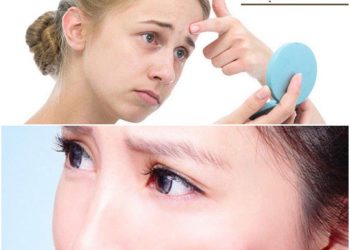 Top 7 kem trị mụn ẩn cho da dầu hiệu quả dài lâu
