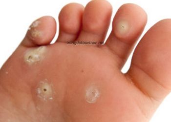 Mụn cơm là gì? Cách nhận biết mụn cơm đơn giản nhất!