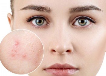 5 công thức trị mụn trứng cá tại nhà tốt nhất hiện nay: an toàn, hiệu quả nhanh