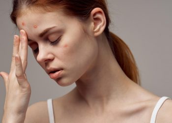 7 thói quen khiến da ngày càng nổi mụn – bạn có mắc phải sai lầm nào không?