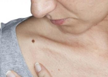 Cách tẩy nốt ruồi an toàn ngay tại nhà nhất định phải biết