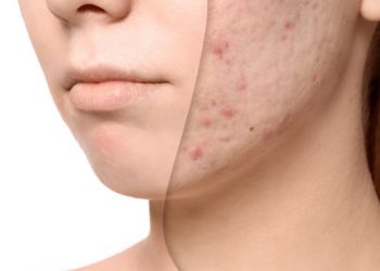 5 phương pháp trị thâm tại nhà bằng nguyên liệu thiên nhiên
