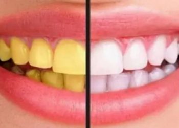 8 cách làm trắng răng tự nhiên đơn giản ngay tại nhà