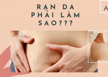 Rạn da phải làm sao? Nguyên nhân, biểu hiện và cách trị rạn da an toàn