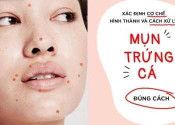 Sẹo mụn do mụn trứng cá: Nguyên nhân, cách điều trị và phòng ngừa