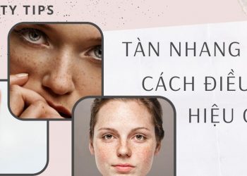 Tàn nhang là gì? Nguyên nhân, biểu hiện và cách trị tàn nhang hiệu quả nhanh, an toàn