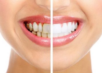 Tìm hiểu nguyên nhân và cách để bạn có hàm răng trắng đẹp mỗi ngày