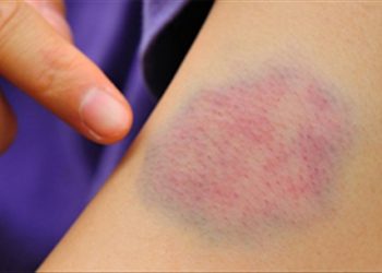 Xử trí đúng cách khi bị sưng bầm không phải ai cũng biết