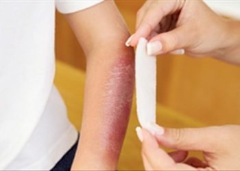 Một số cách chữa bỏng gây ra nhiều tổn thương nguy hiểm khác