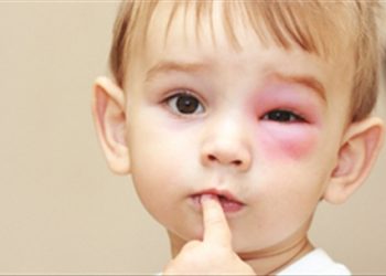 Cách làm tan nhanh vết bầm tím đơn giản và hiệu quả