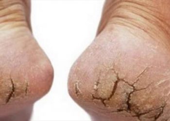 Cách chữa gót chân bị nứt nẻ