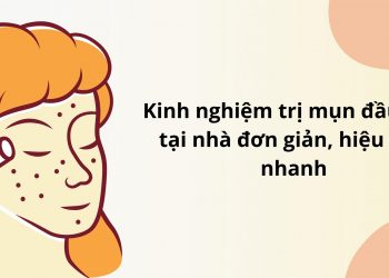 Cách trị mụn đầu đen tại nhà an toàn, hiệu quả, dứt điểm tận gốc