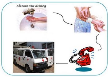 Xử lý ban đầu vết phỏng đúng cách không thể không biết