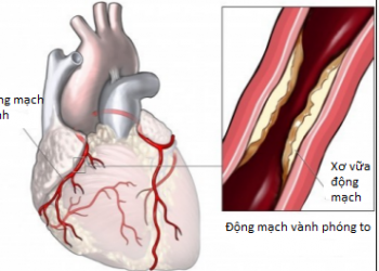 Mách bạn những cách phòng bệnh mạch vành giúp sống khỏe