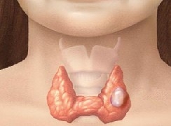 Không phải cứ bướu cổ là phải mổ, hãy áp dụng biện pháp đơn giản này