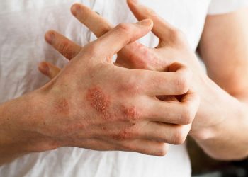 Nổi mụn nước ở tay có thể là triệu chứng của bệnh gì?