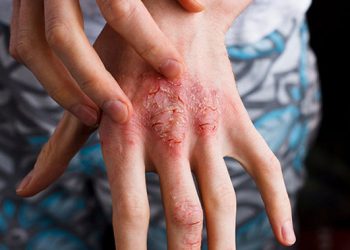 Bệnh viêm da cơ địa: định nghĩa, triệu chứng và yếu tố hình thành