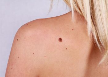 Bác sĩ Da liễu giải thích rõ cách điều trị dày sừng da dầu