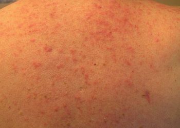 Các bệnh nhiễm trùng da do vi khuẩn phổ biến nhất hiện nay