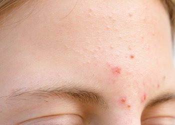 Tìm hiểu 5 nguyên nhân nổi mụn ở vùng trán ít ngờ nhất