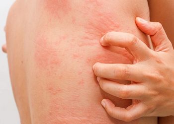 Đi tìm nguyên nhân và biện pháp điều trị khi bị nổi mày đay khắp người