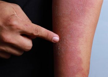 Xử trí như thế nào khi bị viêm da dị ứng cơ địa?
