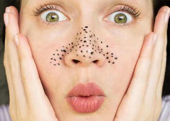 Gợi ý cách trị mụn đầu đen tự nhiên đem lại hiệu quả cao