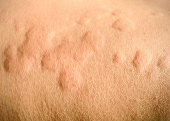Nổi mề đay do lạnh: cách phòng ngừa và điều trị hiệu quả