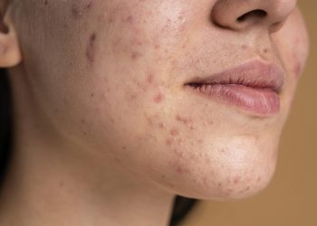 Bí kíp trị thâm mụn đúng cách và hiệu quả