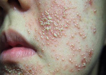 Dấu hiệu da nhiễm corticoid và cách điều trị hiệu quả