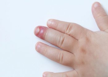 Viêm quanh móng có nguy hiểm không? Cách điều trị như thế nào?