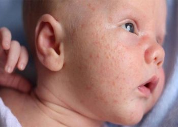Vì sao bé nổi rôm sảy vào mùa hè? Cách điều trị bệnh như thế nào?