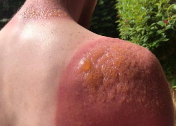 Góc tư vấn: Bị cháy nắng nên làm gì để da sớm hồi phục?