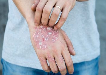 Phương pháp điều trị và phòng ngừa bệnh chàm da eczema hiệu quả nhất