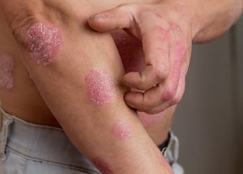 Những nguyên nhân nào gây bệnh chàm da? Phương pháp điều trị bệnh ra sao?