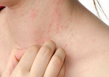 Nguyên nhân gây nổi rôm sảy ở người lớn và cách điều trị hiệu quả