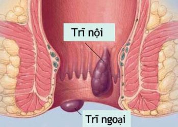 Các phương pháp điều trị bệnh trĩ ngoại ngay tại nhà