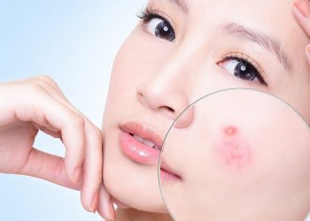 9 thành phần thiên nhiên làm mờ sẹo mụn ai cũng có thể áp dụng