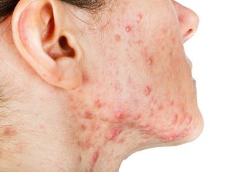 Cách trị mụn bọc hiệu quả ngăn ngừa mụn quay trở lại