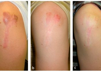 Cách trị sẹo lồi đơn giản tại nhà, đánh bay nỗi ám ảnh của chị em