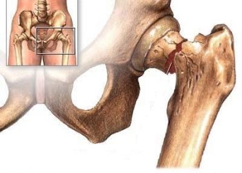 Hậu quả của loãng xương gây ra đối với sức khỏe chúng ta