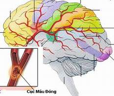 Mẹo hay giúp cấp cứu tai biến mạch máu não bằng Đông y