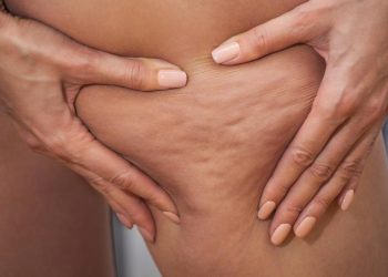 Cách trị da sần vỏ cam đơn giản và hiệu quả