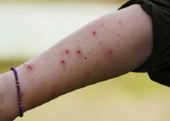Bí quyết đơn giản giúp bạn tránh bị muỗi đốt cực kỳ hiệu quả