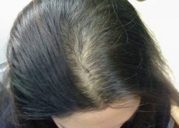 Giải toả nỗi lo rụng tóc chỉ bằng những mẹo đơn giản sau