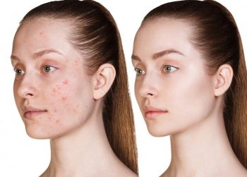 “Cẩm nang” về Salicylic Acid – Tất cả kiến thức bạn cần biết về thành phần này