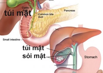 Cách phòng tránh sỏi mật để không gây biến chứng nguy hại