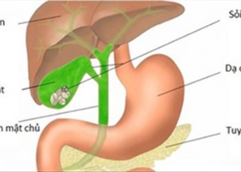 Chữa sỏi mật không cần mổ